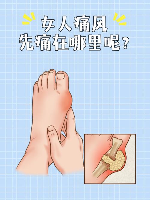 女人痛风会影响怀孕吗