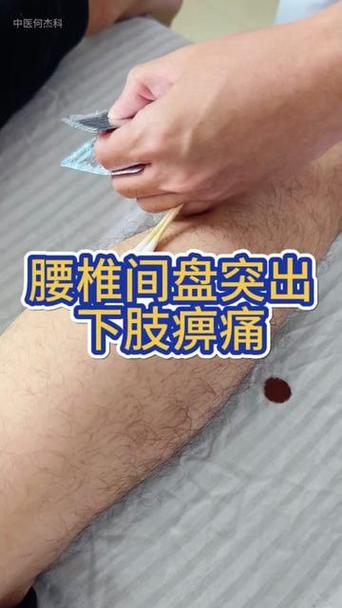 腰间盘突出针灸有效吗