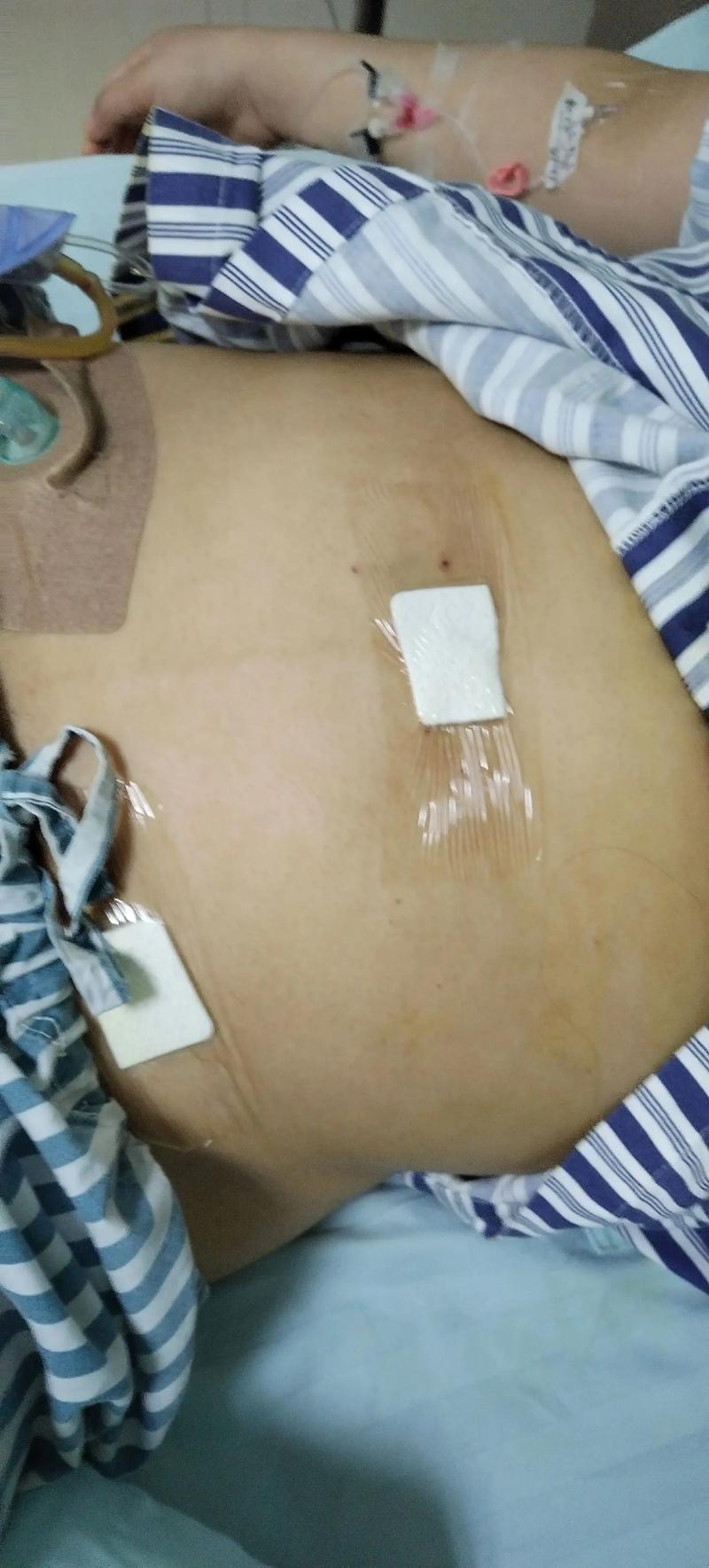 针灸治疗溃疡性结肠炎