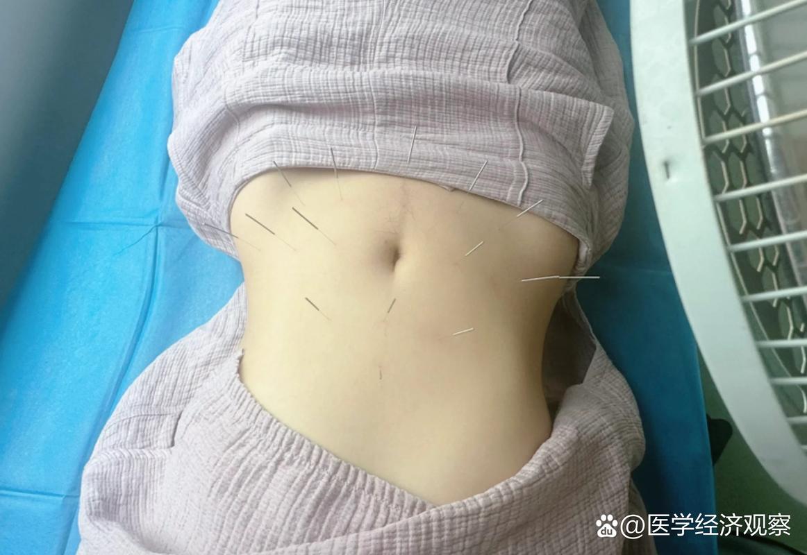 江苏省中医院针灸减肥