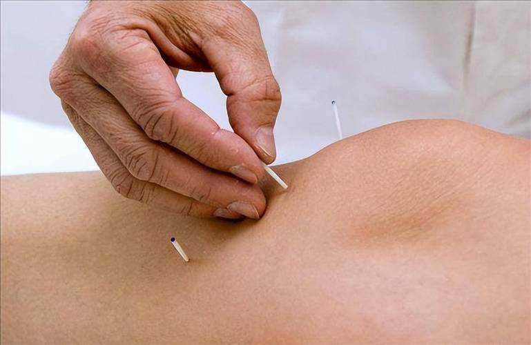 针灸治疗膝关节炎视频