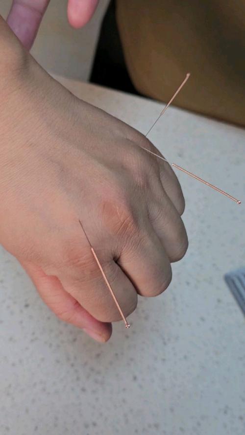 针灸治疗颈椎病有用吗