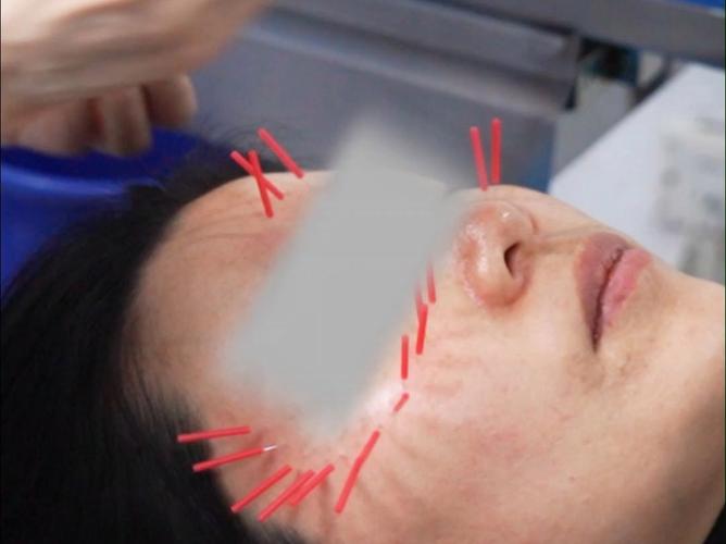 针灸治疗黄褐斑的效果