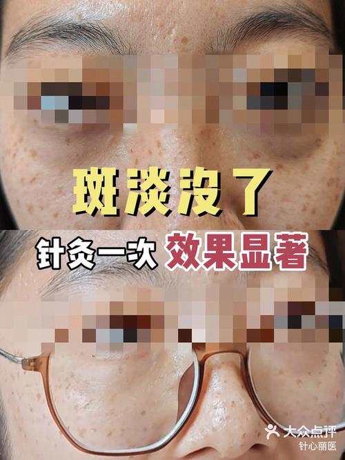 针灸治疗黄褐斑的效果