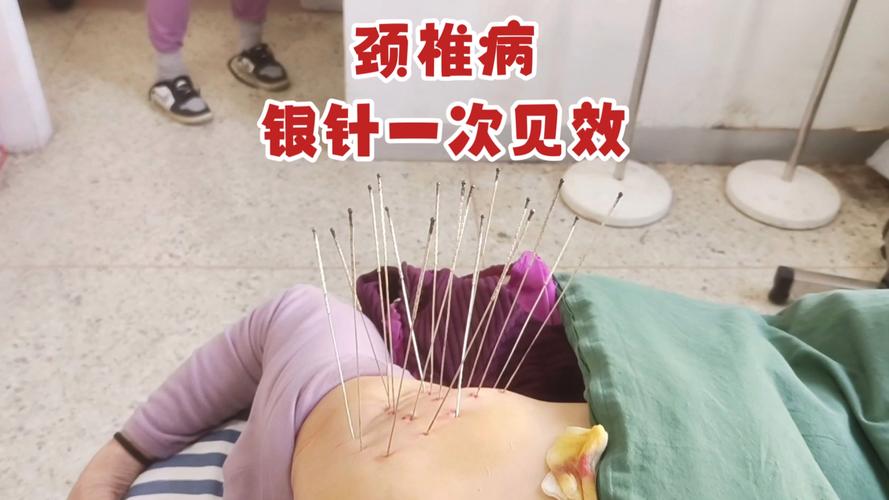 针灸治疗脊髓型颈椎病