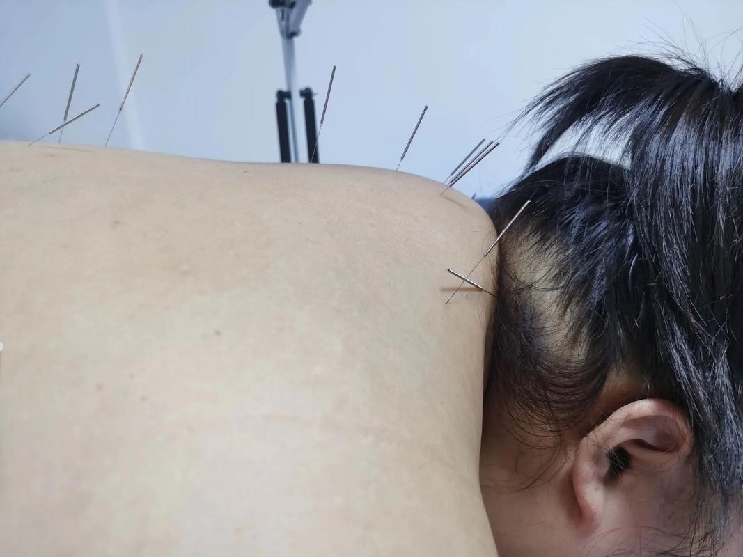 淋巴结肿大针灸能治疗