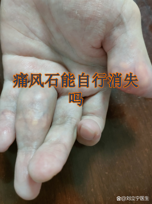 痛风结节能自行消除吗