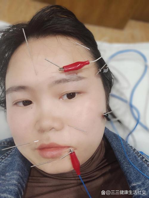 面部神经炎针灸后脸肿