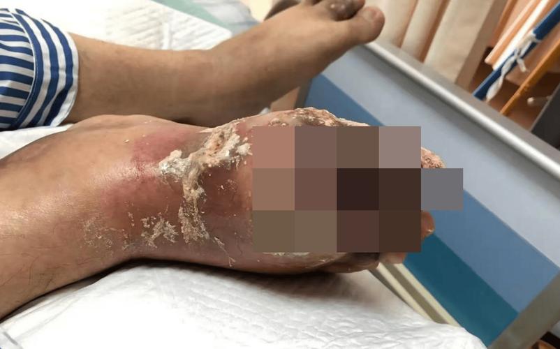 痛风开刀后伤口不愈合