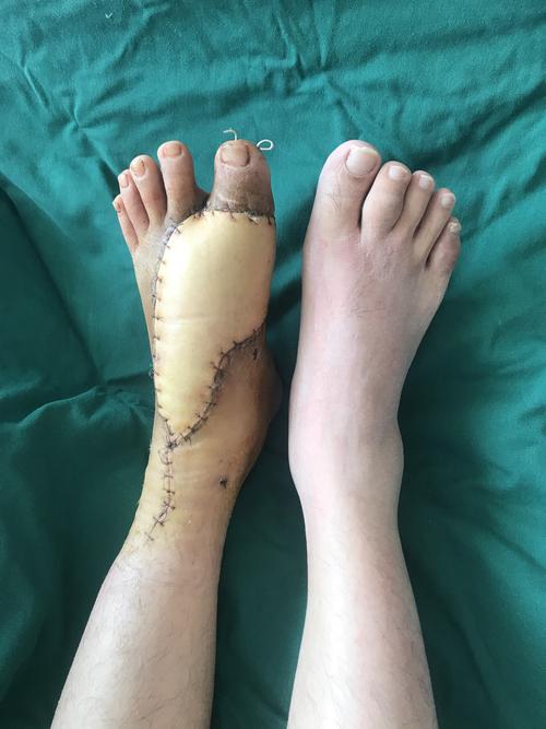 痛风开刀后伤口不愈合