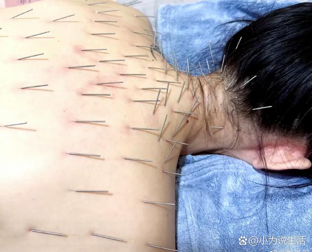 腰椎间盘突出针灸效果