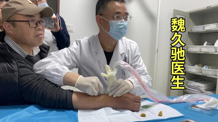 桡骨茎突腱鞘炎 针灸