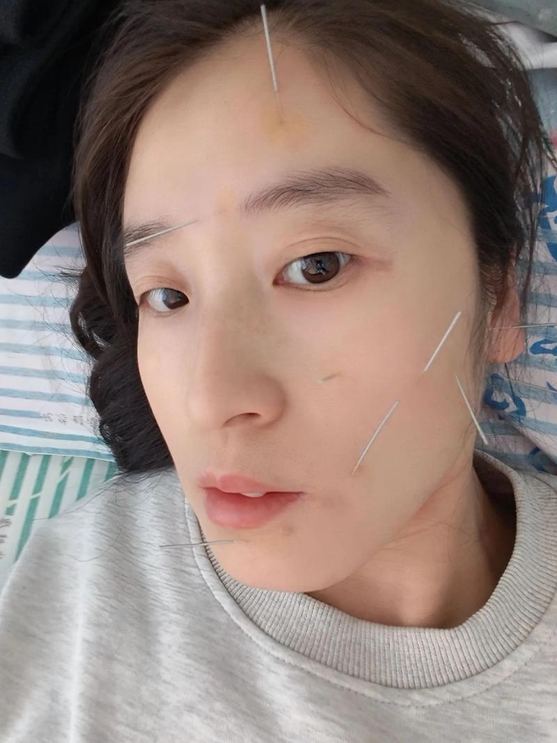 针灸治疗面瘫后遗症吗