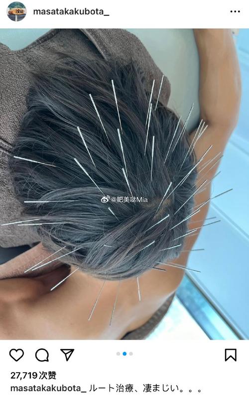 针灸能治疗小脑萎缩吗