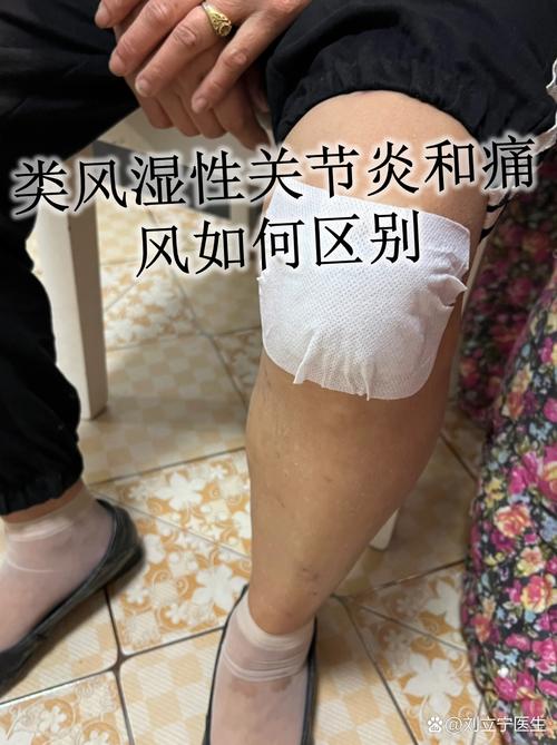 和痛风相似还有什么病