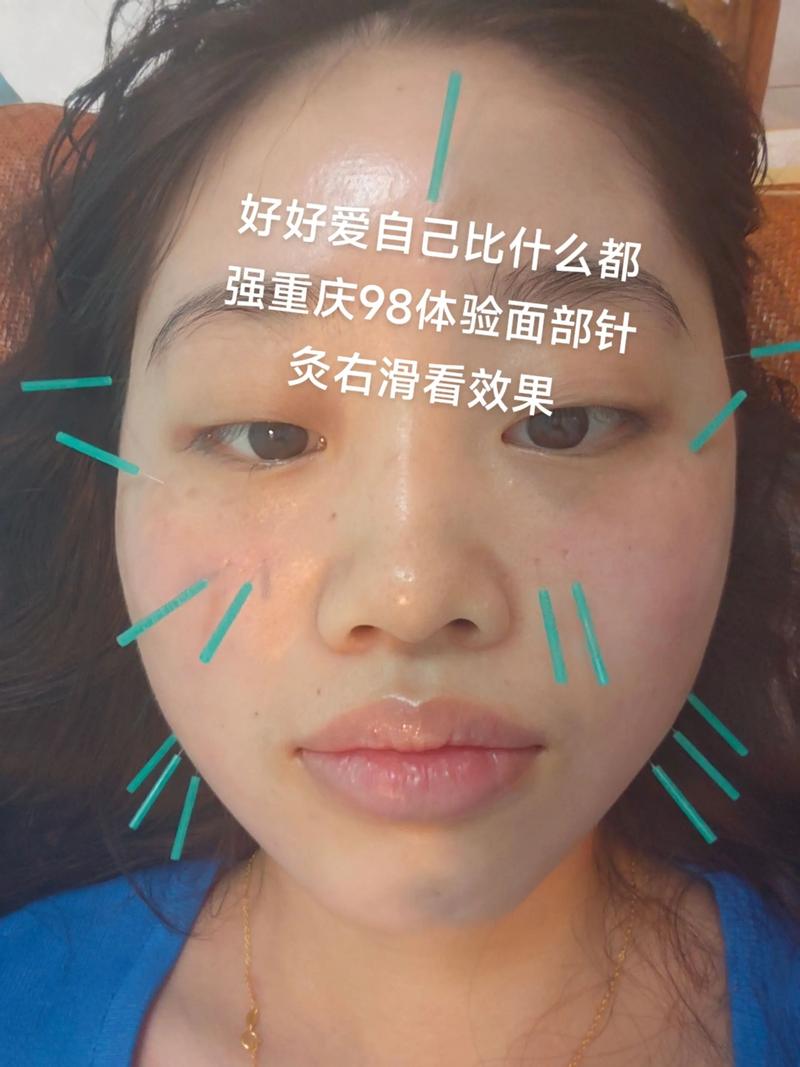 面部针灸后多久能洗脸