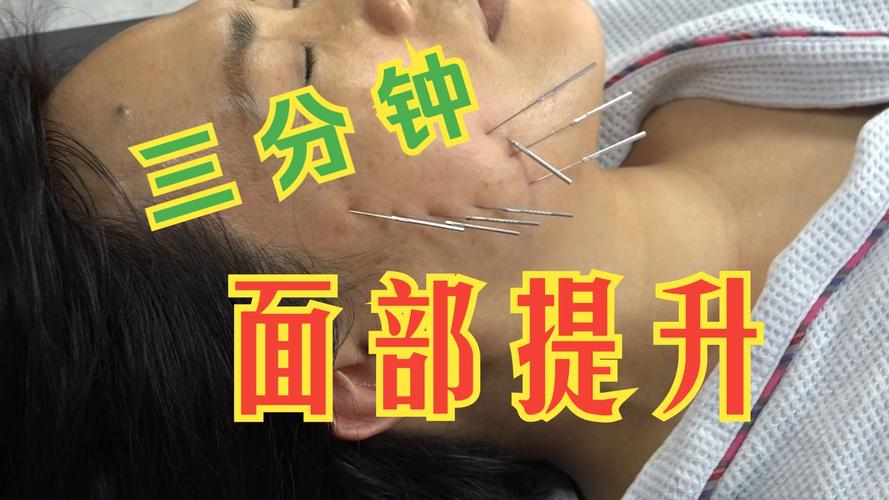 面部针灸后多久能洗脸