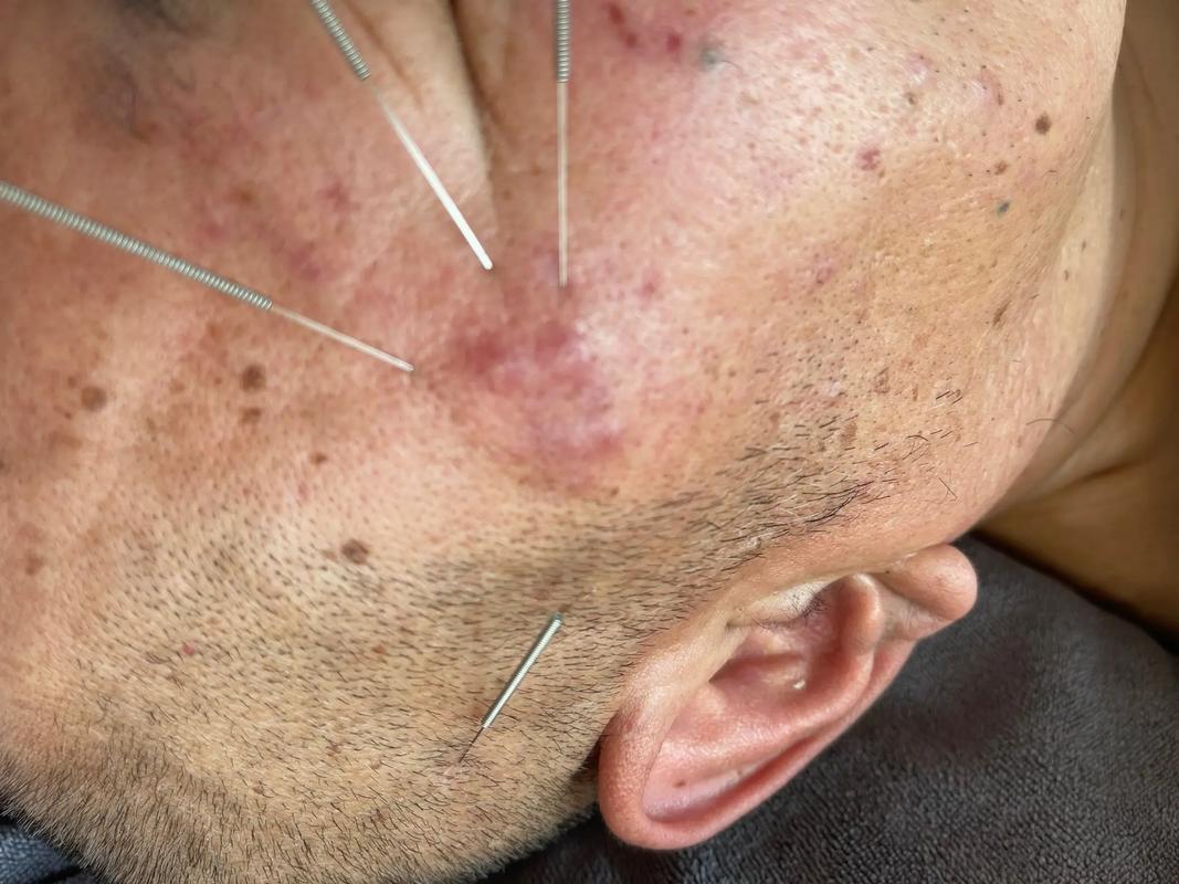 脸上长痘痘可以针灸吗