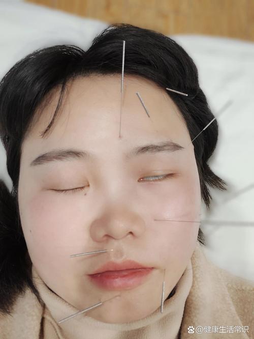 针灸治疗动眼神经麻痹