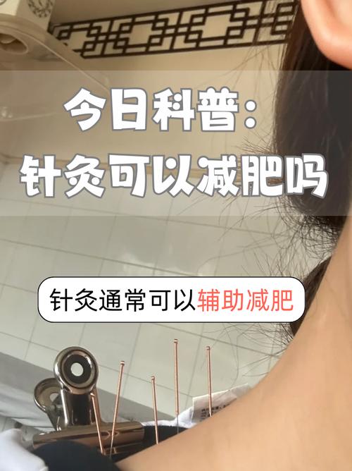 铜陵哪里有针灸减肥的