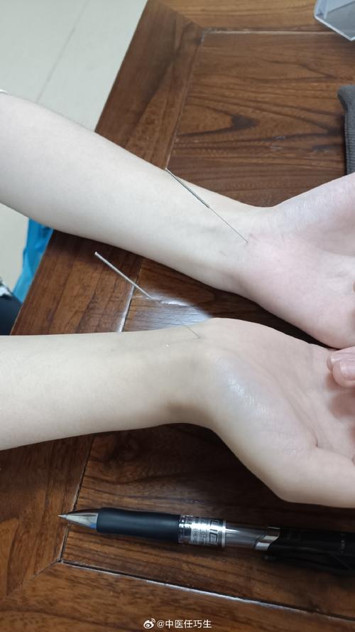 铜陵哪里有针灸减肥的