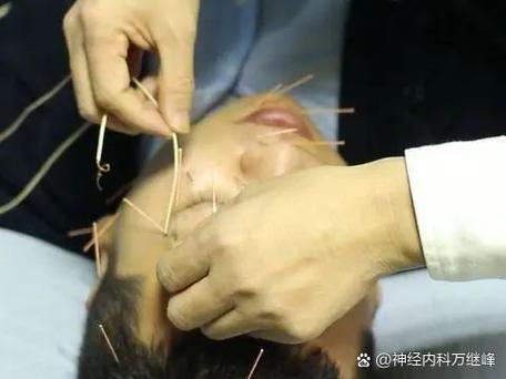 面瘫针灸什么时候开始