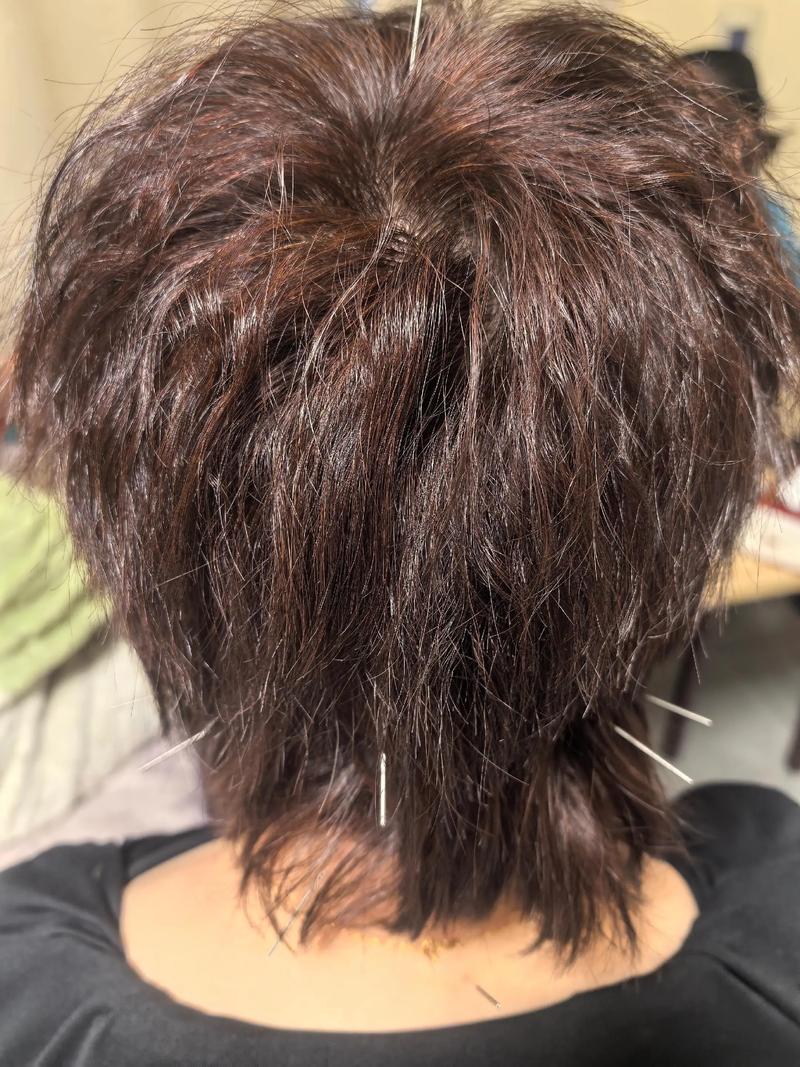 颈椎牵引好还是针灸好