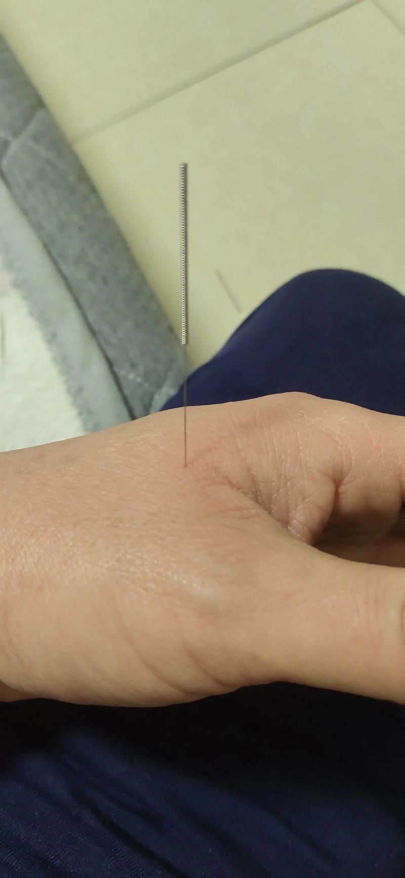 针灸过后疼痛怎么回事