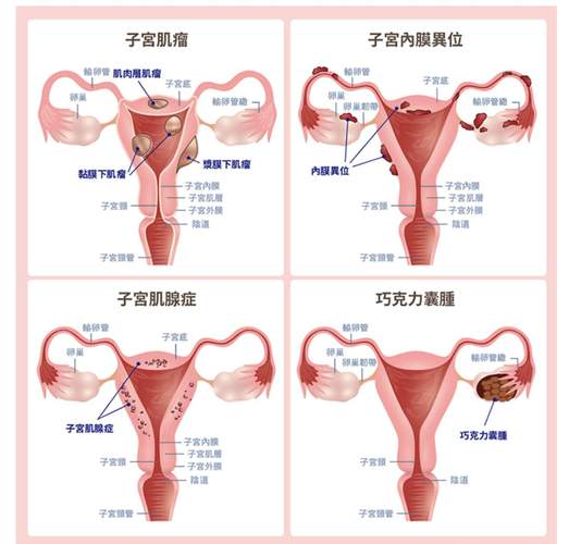 针灸 子宫内膜异位症