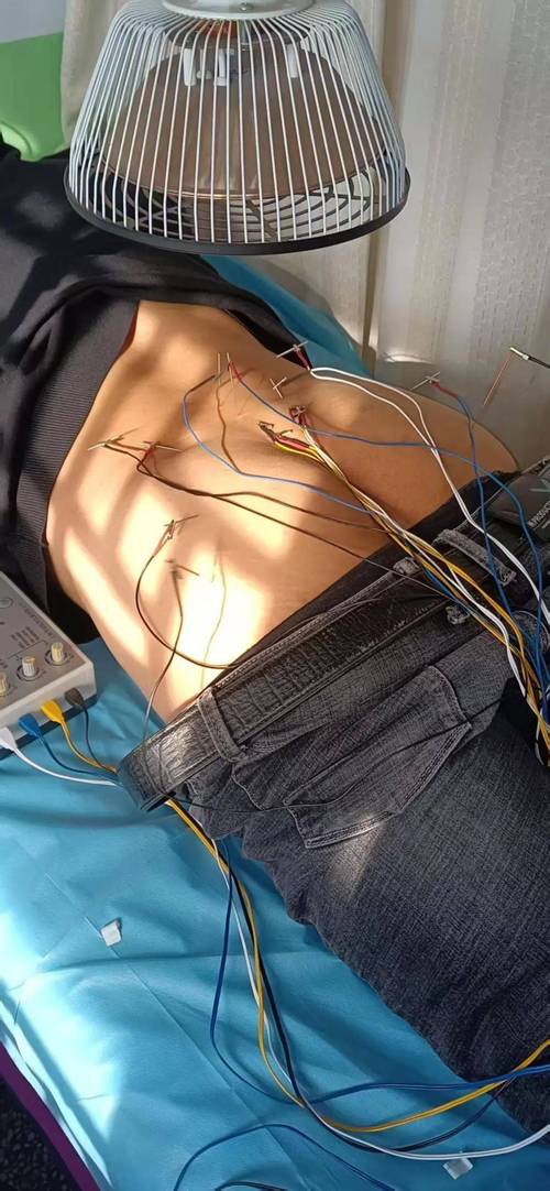 颈椎病的针灸门诊病历