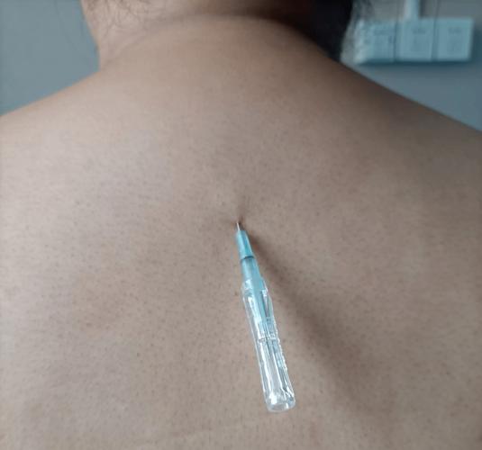 颈椎病的针灸门诊病历