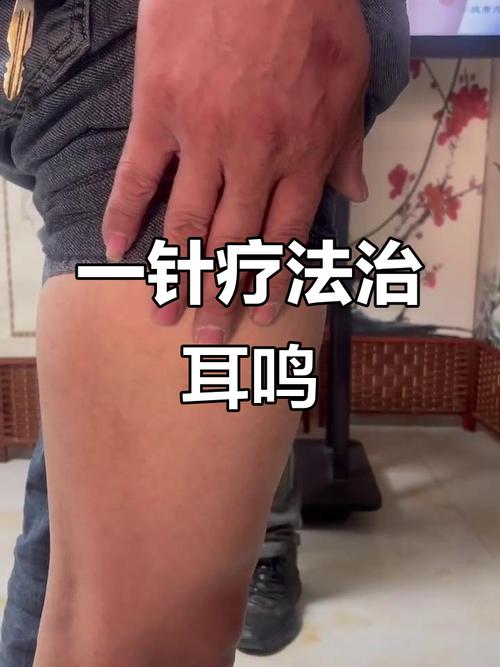 耳鸣针灸 多少钱一次