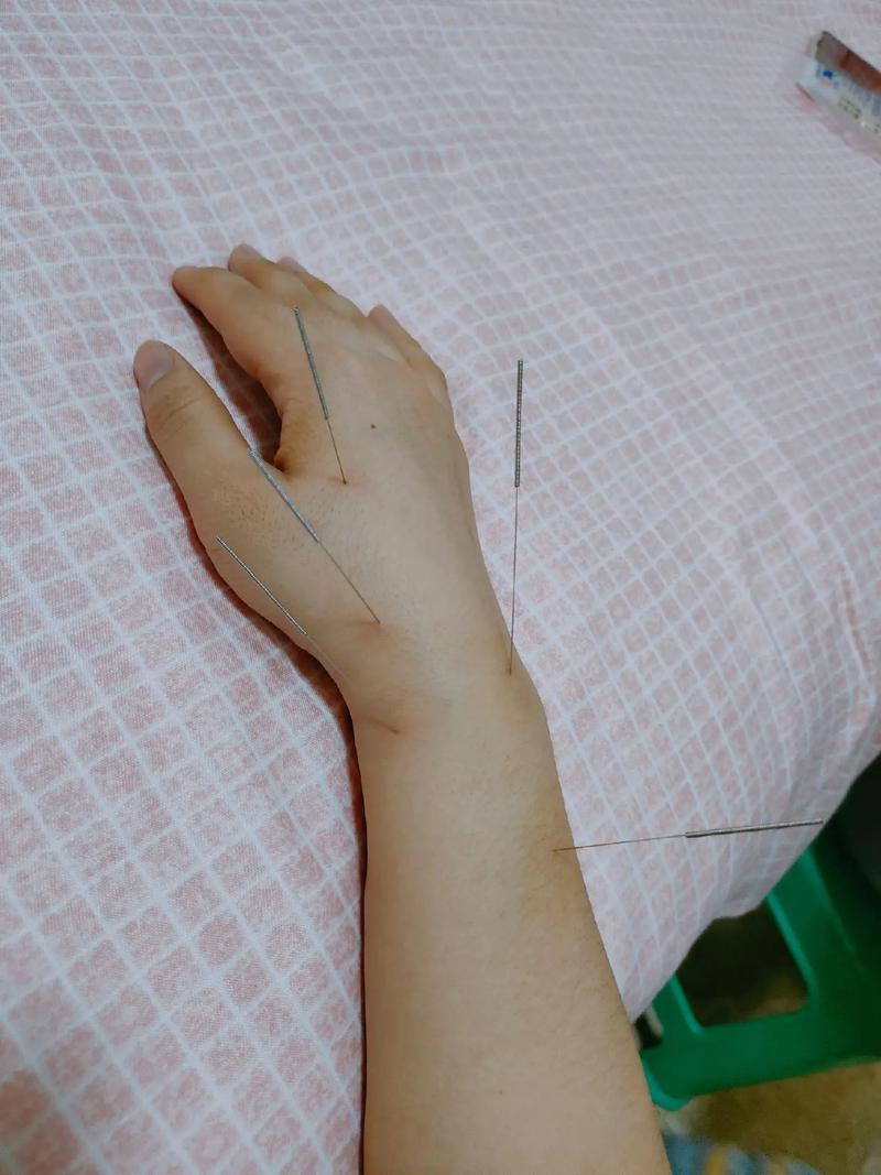 腕管综合征的针灸治疗
