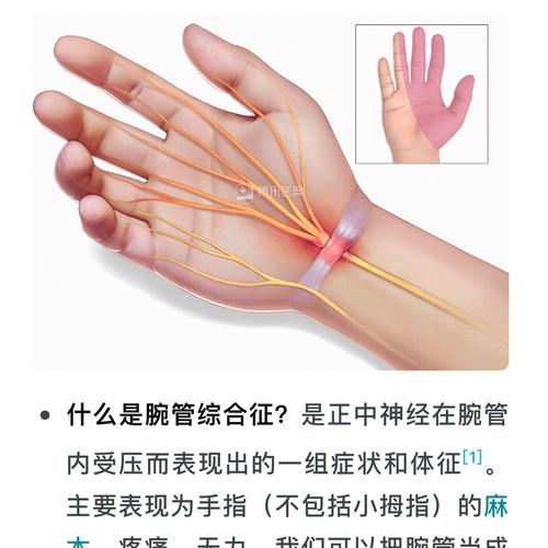 腕管综合征的针灸治疗