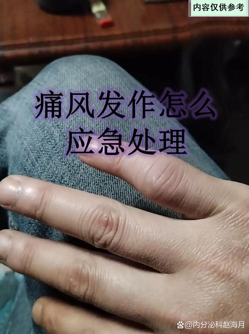痛风急性发作几天能好