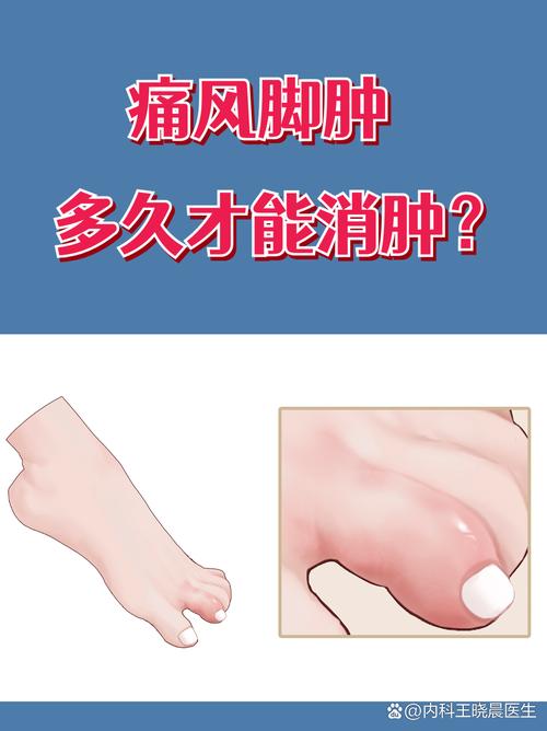 痛风急性发作几天能好