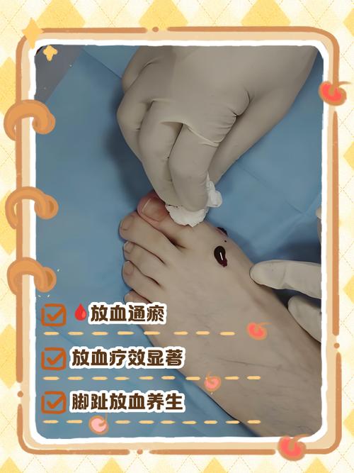 神经性皮炎 针灸放血