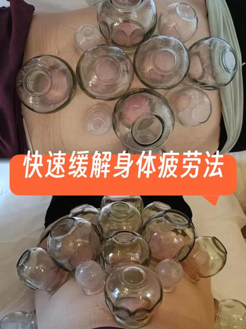 减肥针灸好还是拔罐好