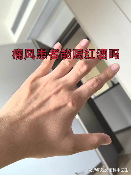 喝酒引起痛风怎么治疗