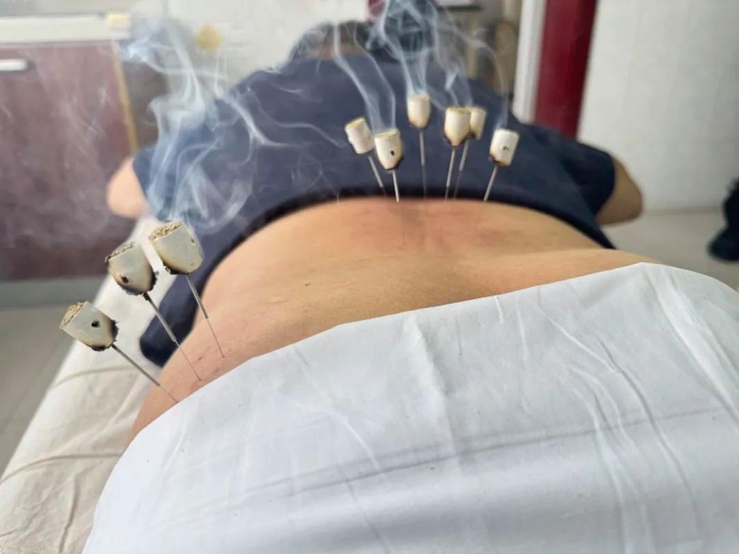 腰椎间盘突出针灸电疗