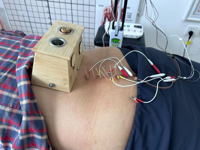 腰椎间盘突出针灸电疗