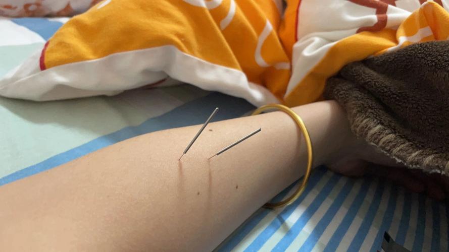 不知道怀孕了做了针灸