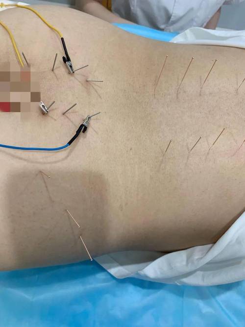 不知道怀孕了做了针灸