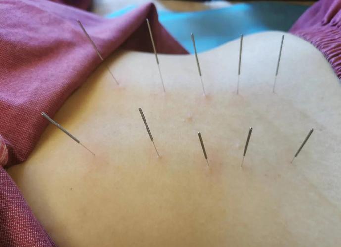 顽固性呃逆的针灸治疗