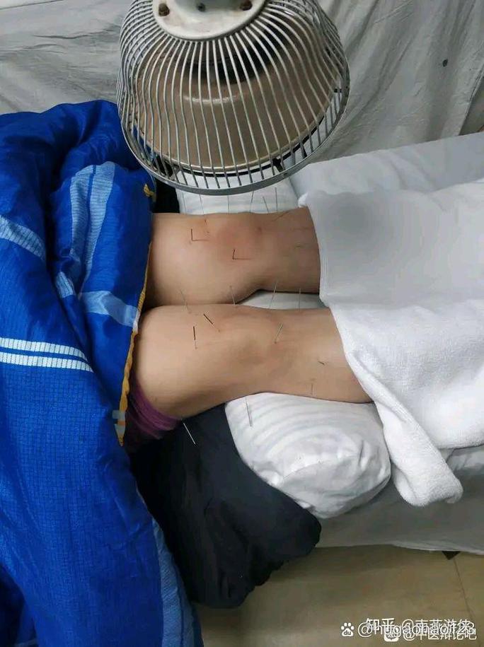 针灸 膝关节骨质增生