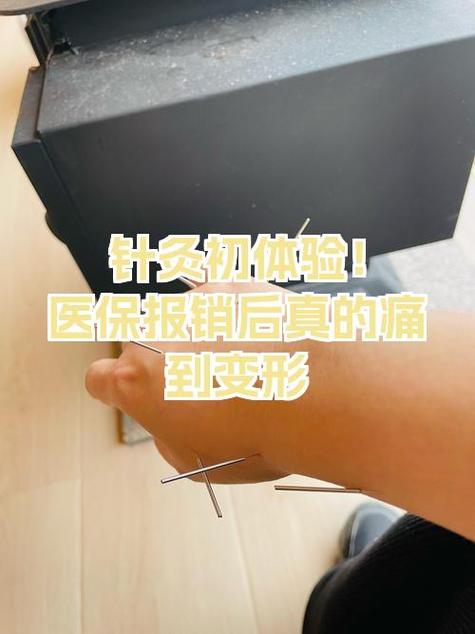 上海可以用医保的针灸