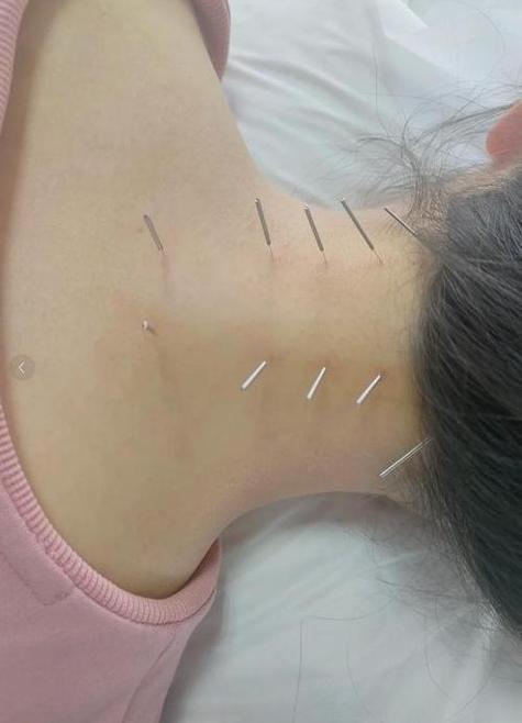 脊髓型颈椎病针灸治疗