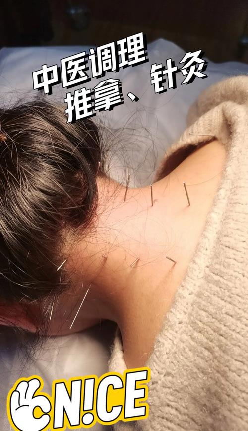 脊髓型颈椎病针灸治疗