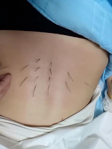 针灸直接腰椎间盘突出