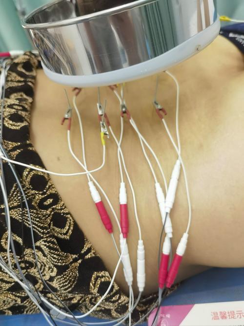 针灸直接腰椎间盘突出